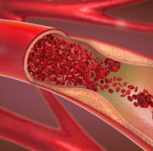 Arterial Treatment