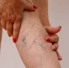 Varicose Veins